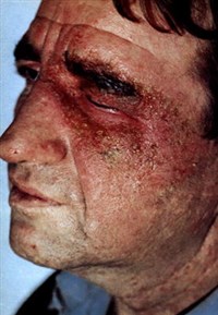 Острая Стадия экземы, поражение кожи лица