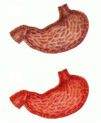 Острый гастрит