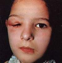 Острый дакриоаденит