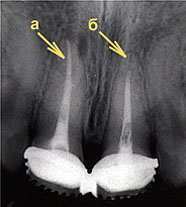 ПЛОМБИРОВАНИЕ КАНАЛОВ