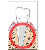 Пародонтит