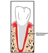 Периодонтит