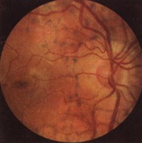 Пигментная дистрофия сетчатки (центральная часть)
