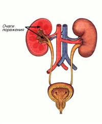 Пиелонефрит