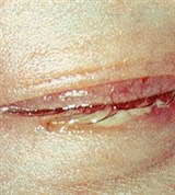 Пневмококковый Конъюнктивит