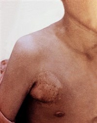 Подмышечный бубон