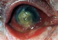 Ползучая язва роговой оболочки (1)