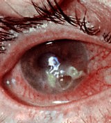 Ползучая язва роговой оболочки (2)