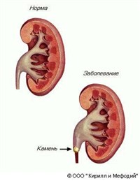Почечнокаменная болезнь (схема)