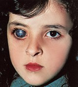 Правосторонний буфтальм