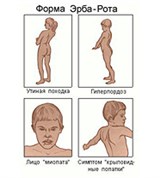 Прогрессирующая мышечная дистрофия