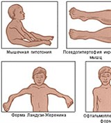 Прогрессирующая мышечная дистрофия. форма дюшена