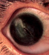 Проникающее ранение роговицы и капсулы хрусталика