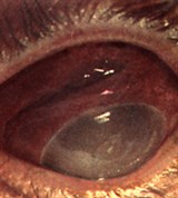 Проникающее ранение склеры