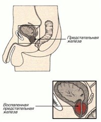 Простатит