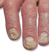 Псориаз. поражение ногтей (атрофия)
