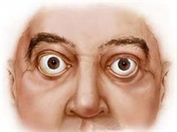 Пучеглазие (рисунок)