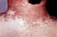 Пятнистая сыпь