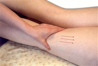 РАСТИРАНИЕ «ЩИПЦАМИ» НА КОЛЕННОМ СУСТАВЕ