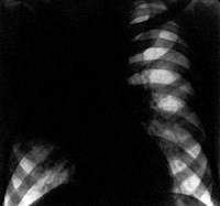 РЕНТГЕНОВСКОЕ ИЗОБРАЖЕНИЕ ПНЕВМОНИИ