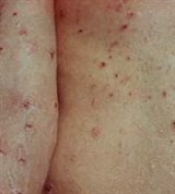 Распространенный нейродермит
