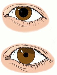 Реакция зрачка на свет