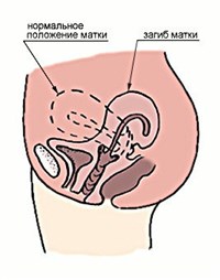 Ретрофлексия матки