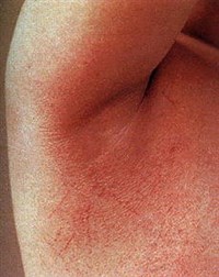 СКАРЛАТИНОЗНАЯ СЫПЬ