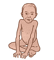 СПИНАЛЬНАЯ АМИОТРОФИЯ (клинические симптомы)