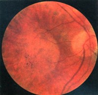 СТАРЧЕСКАЯ ДИСТРОФИЯ СЕТЧАТКИ (1)