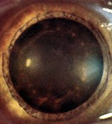 Сидероз глаза