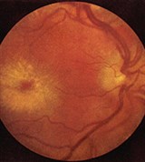 Старческая дистрофия сетчатки (2)