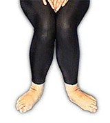 Стопы на ребрах