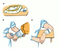 ТЕХНика НАКЛАДЫВАНИЯ СОГРЕВАЮЩЕГО КОМПРЕССА