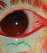 Тотальная Гифема