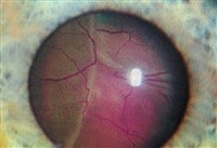 Тотальная пузыревидная отслойка сетчатки