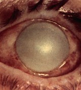 Тяжелый ожог конъюнктивы и роговицы