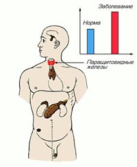 УРОВЕНЬ ГОРМОНА ПРИ ГИПЕРПАРАТИРЕОЗЕ