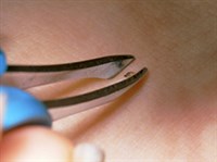 Укусы клещей