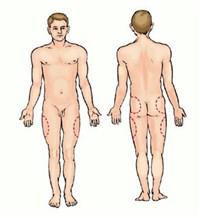 Участки тела для внутримышечных инъекций