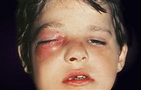 Флегмона глазницы (1)