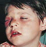 Флегмона глазницы (2)