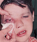 Флегмона глазницы (3)