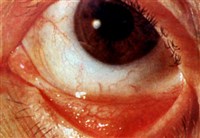 Фолликулез конъюнктивы