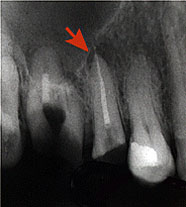 ХРОНИЧЕСКИЙ ГРАНУЛИРУЮЩИЙ ПЕРИОДОНТИТ ПОСЛЕ ПЛОМБИРОВАНИЯ КАНАЛА