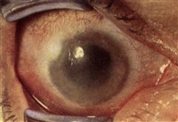 Химический ожог конъюнктивы и роговицы