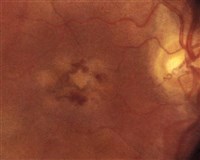 Хориоретинит (начальная стадия)