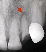 Хронический гранулирующий периодонтит до лечения