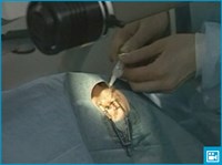 ЭКСИМЕР-ЛАЗЕРНАЯ КОРРЕКЦИЯ ЗРЕНИЯ (видео)