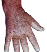 Экзема кисти